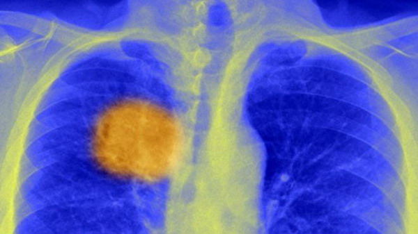 Британские ученые обещают: скоро рак будут лечить одним уколом