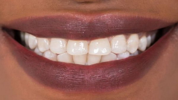 Зубы можно заставить самостоятельно восстанавливать повреждения: новое вещество