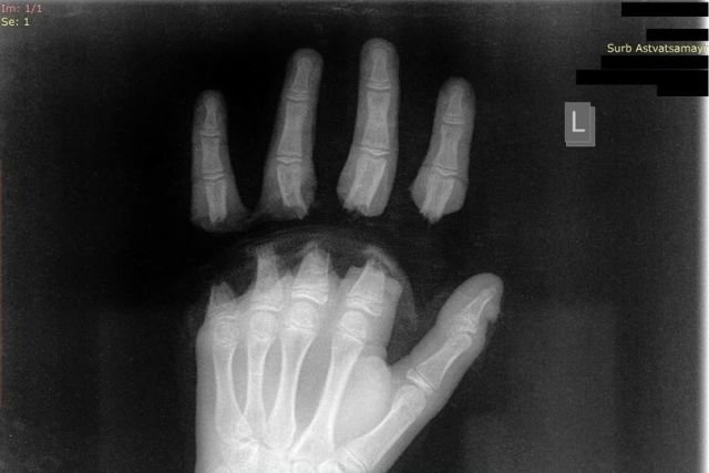 Ребенка оперировали 10 часов, пластические хирурги провели реплантацию пальцев руки