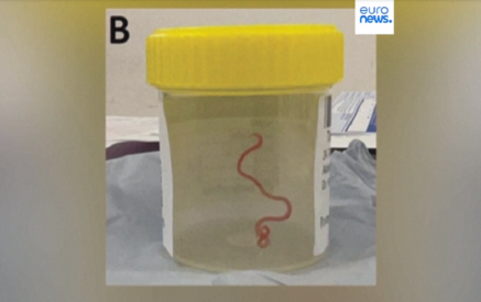 В Австралии в мозгу женщины нашли живого 8-сантиметрового червя. Euronews